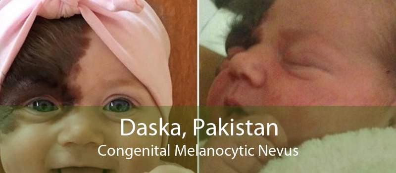 Daska, Pakistan Congenital Melanocytic Nevus