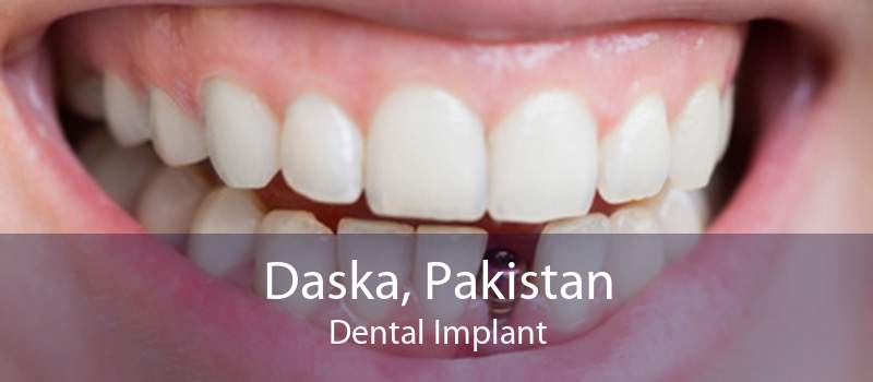 Daska, Pakistan Dental Implant