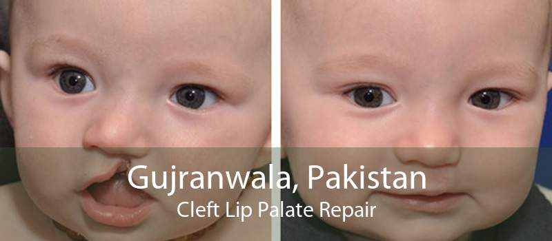 Gujranwala, Pakistan Cleft Lip Palate Repair