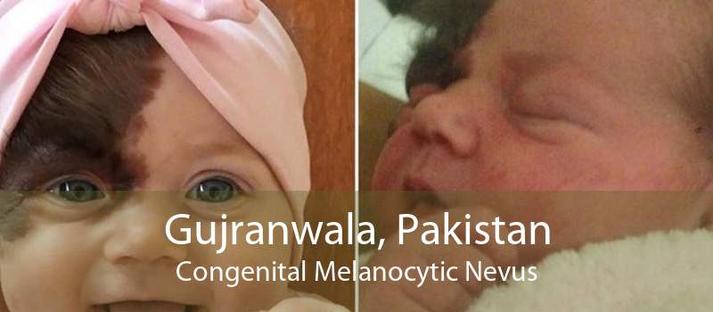 Gujranwala, Pakistan Congenital Melanocytic Nevus