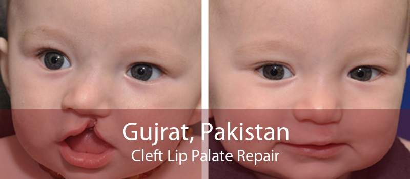 Gujrat, Pakistan Cleft Lip Palate Repair