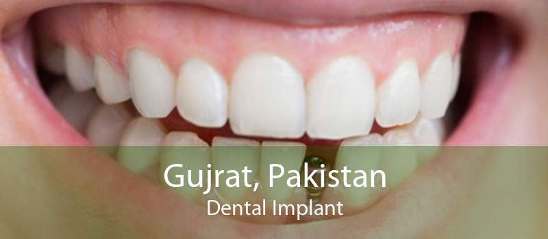 Gujrat, Pakistan Dental Implant