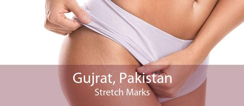 Gujrat, Pakistan Stretch Marks