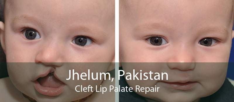 Jhelum, Pakistan Cleft Lip Palate Repair