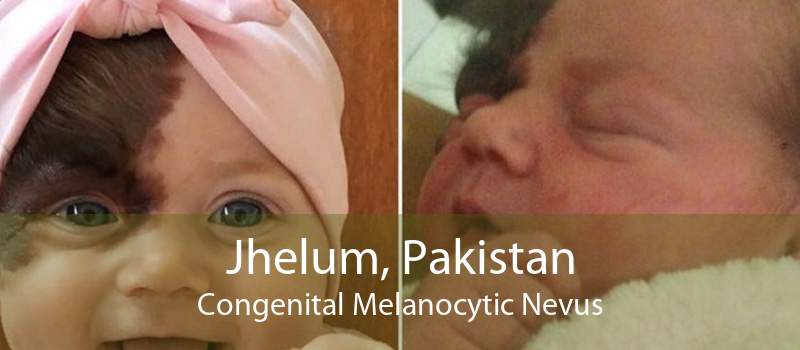 Jhelum, Pakistan Congenital Melanocytic Nevus