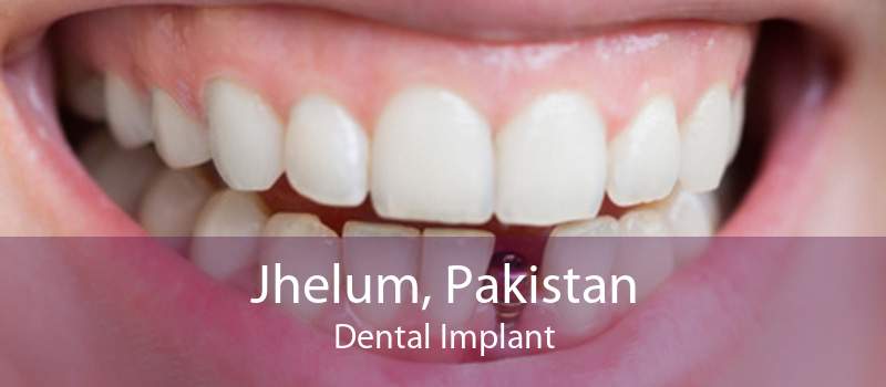 Jhelum, Pakistan Dental Implant