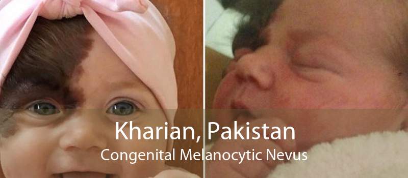 Kharian, Pakistan Congenital Melanocytic Nevus