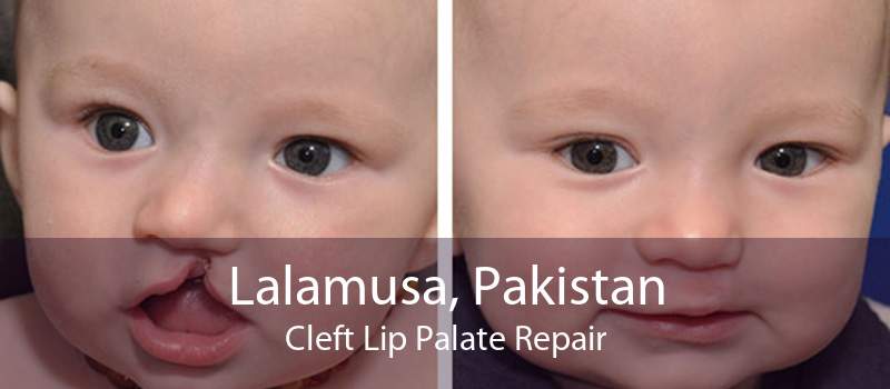 Lalamusa, Pakistan Cleft Lip Palate Repair