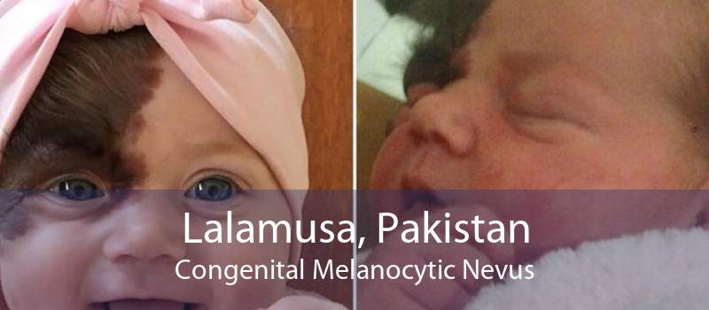 Lalamusa, Pakistan Congenital Melanocytic Nevus