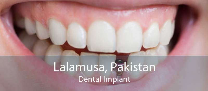 Lalamusa, Pakistan Dental Implant