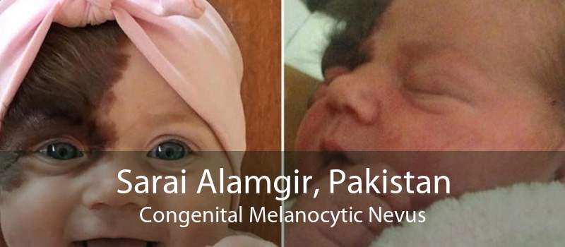 Sarai Alamgir, Pakistan Congenital Melanocytic Nevus