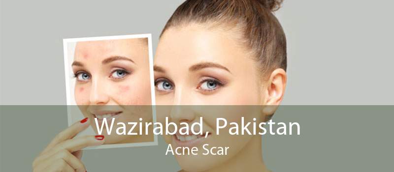 Wazirabad, Pakistan Acne Scar