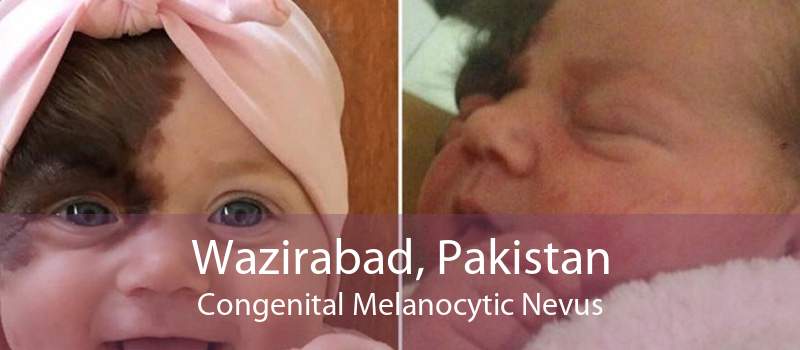 Wazirabad, Pakistan Congenital Melanocytic Nevus