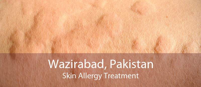 Wazirabad, Pakistan Skin Allergy Treatment